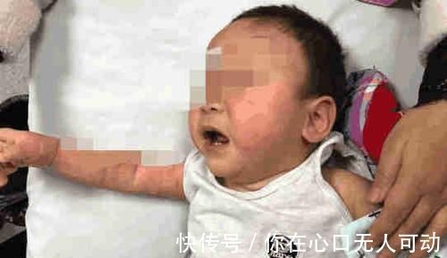 孩子|孩子烫伤后, 最佳治疗时间只有2分钟, 你知道该怎么做吗