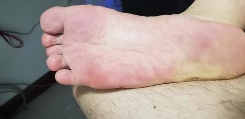 慢性疾病|医生提示:糖尿病患者在出现糖尿病足时,早期一般有这3大症状