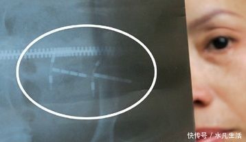 节育环|宝妈为了生二胎,决定去医院取出节育环,但没到会变成“利器”