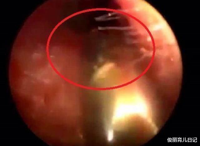 孩子|男童半夜耳朵疼,妈妈拿灯一照马上去医院,回家立刻丢东西