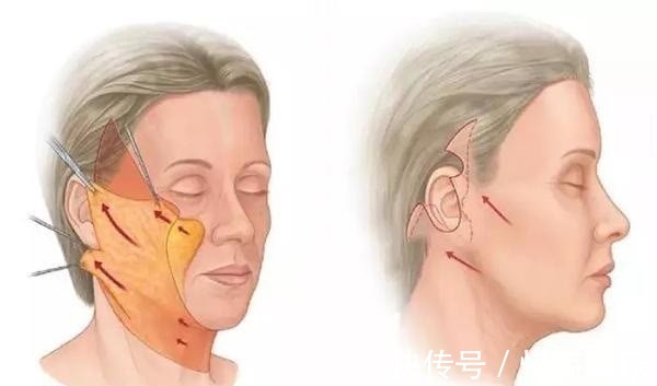 小拉皮 拉皮除皱王小民教授:46岁的她选择了小拉皮手术,看看效果反馈!