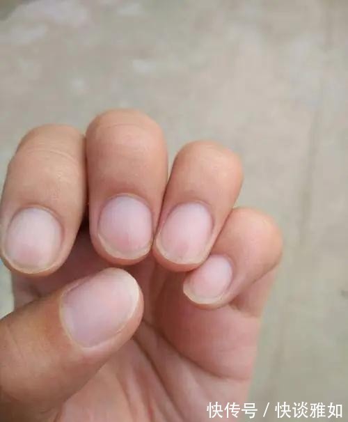 半月痕|手指甲上有月牙的人,与没有月牙的人,谁的身体更健康?