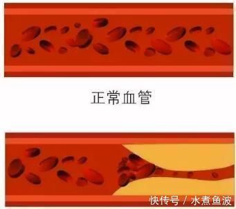 冠心病|三位院士声明开水里加一勺，连喝15天，血管通透明亮，血脂悄悄