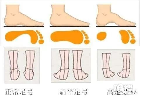 扁平足|姑娘穿平底鞋,走一天路痛到不行…原来穿鞋还得看脚型?