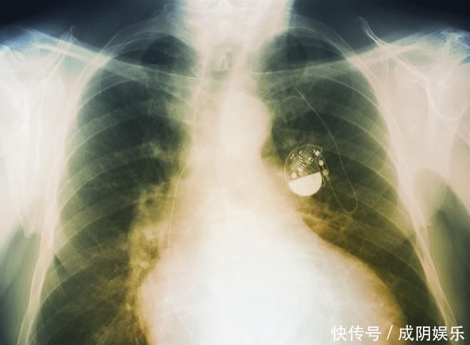 病例|5个真实病例告诉我们:高血压可能没有任何表现,但是危害巨大