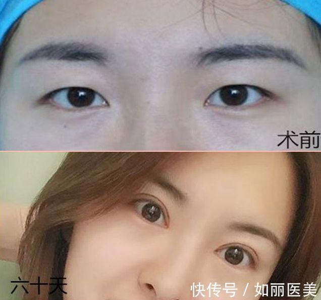 重睑 什么是割双眼皮呢？割双眼皮手术都包含哪些项目？你都了解吗
