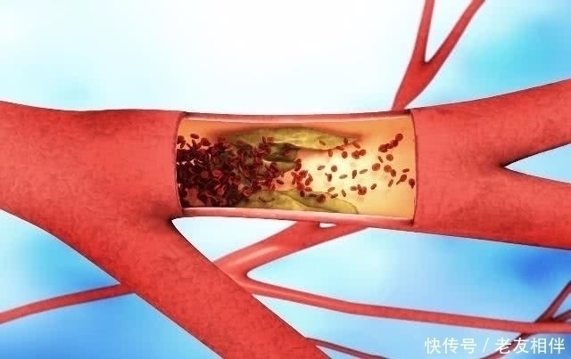 普洱茶|天然“阿司匹林”找到了，每天吃点，或许帮血管轻松“洗个澡”