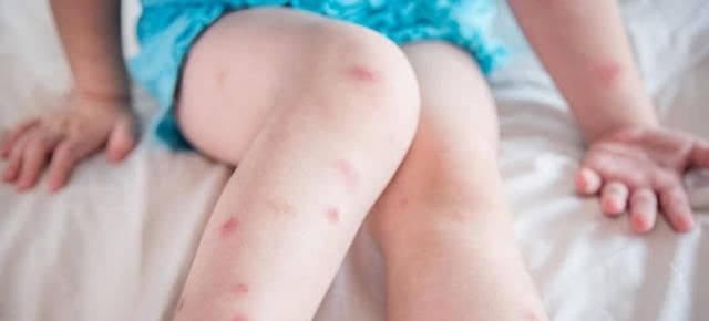 麻烦|小蚊虫大麻烦，宝宝眼睛都肿了，驱蚊止痒，妈妈只用8个小妙招