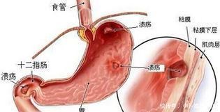 反酸|消化科大夫：养胃很简单，这3种食物，你若喜欢吃，胃病绕道走