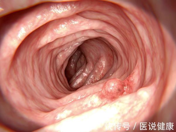 癌肿|排便有4个症状找上你时，当心是肠道已发生癌变，及时检查