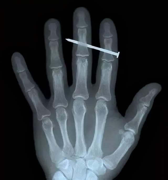 伦琴|做B超前涂的那层黏黏的、凉凉的液体是什么?做完要马上洗掉吗?