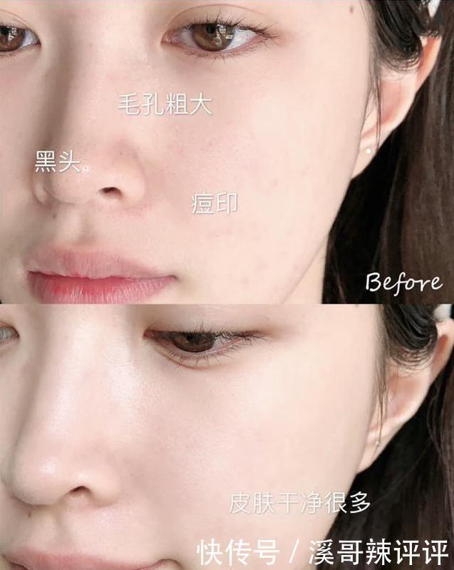 冒出闭口、粉刺不要怕!注意这三个点,