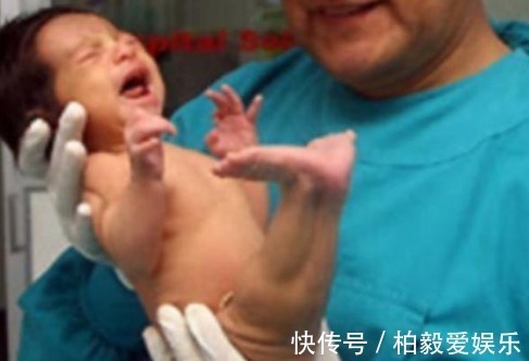 综合症|女童出生便患有美人鱼症,喜欢在水里的感觉,用乐观战胜缺陷