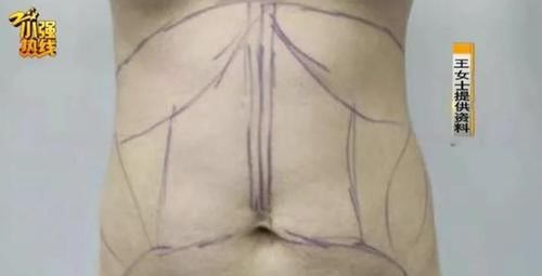 女子花近3万做抽脂手术，结果出现大面积淤青：老公都不敢碰我了