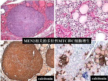 副神经节瘤|「其他部位神经内分泌肿瘤」学习笔记