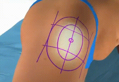 收费标准 抽脂手术动图演示手术原理!效果好吗?价格+选择攻略,助力好身材!