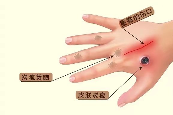 感染|炭疽是什么？可怕吗？德州疾控中心为你讲个明白！