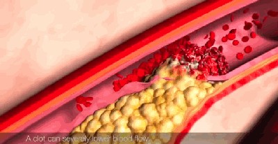 医生|动脉粥样硬化有何危害？是否真的能够被逆转？听听医生怎么说