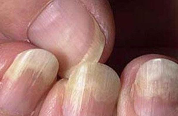 检查|指甲如果长成5种样子,说明你的身体状况不是太好,需要检查了