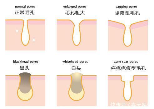 收敛毛孔，除了光子嫩肤，这两种方法也很出色