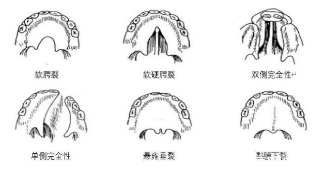 科普|天使科普：唇裂腭裂早知道