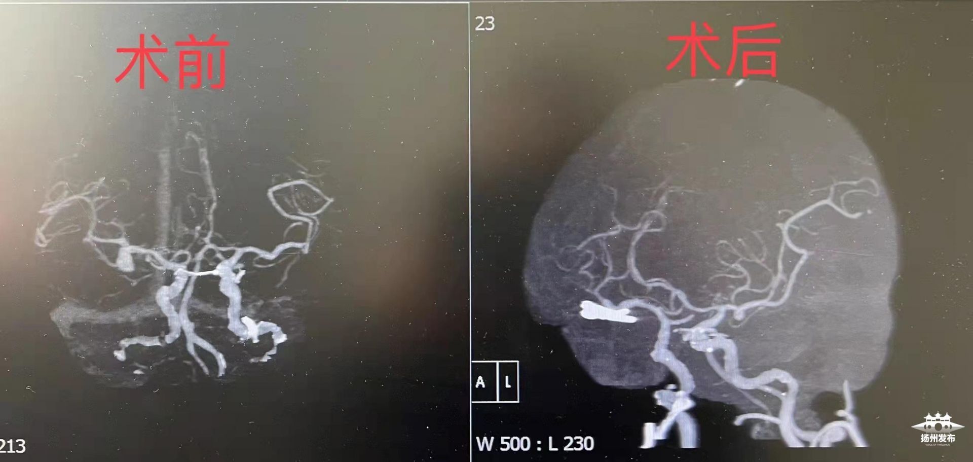 动脉瘤破裂|【萍安健康】74岁大妈突然头痛欲裂 原来是脑内的“炸弹”在示警