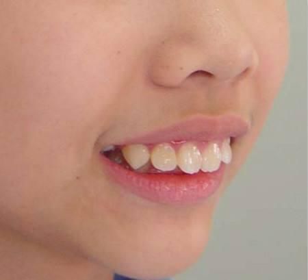 妈妈|15岁男孩长出“尖牙”,妈妈亲手摸过后吐槽:养了个“吸血鬼”