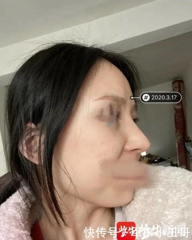 女子整容后山根晃动、鼻尖发白!手术方:很成功,已起诉