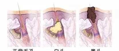 黑头 毛孔粗大难改善4种毛孔问题对症下药|医美科普!