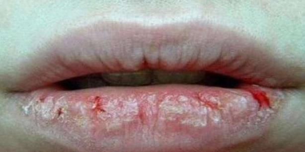 嘴唇|嘴巴上出现死皮,一撕一长条钻心疼?4种病作祟,看完立马停手