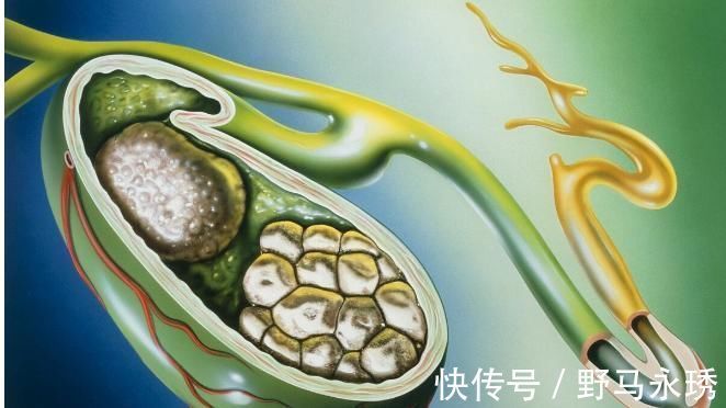 胆结石|早餐就要吃得好，坚持做到“3不吃2个一”，远离3个健康问题