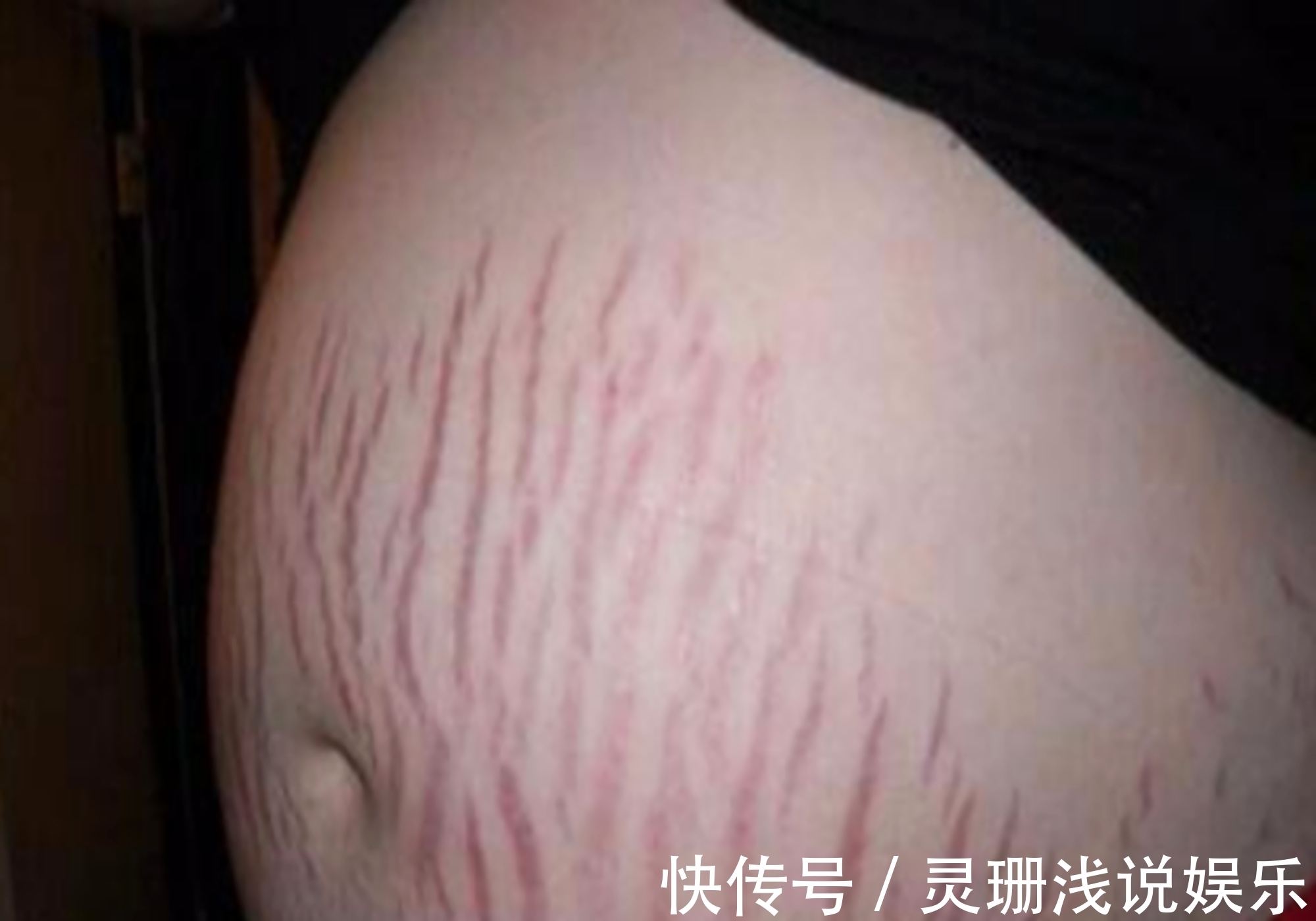 妊娠纹|孕期妊娠纹也挑人,4类孕妈躲得开,如果你全都符合,真让人羡慕