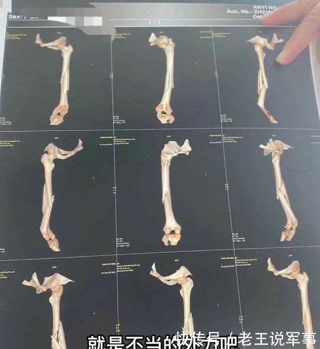 股骨干|女子第一次上私教课,练瑜伽被教练压断大腿!网友:下手太狠了!