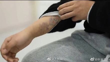 未成年人后悔文身 花6000洗不掉