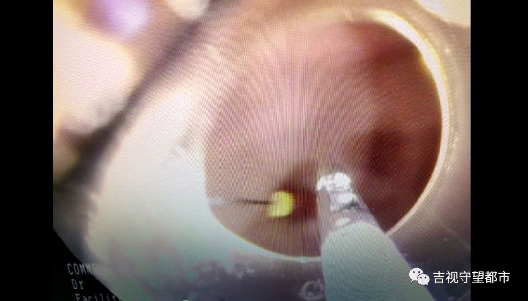 消化道|牙修一半针没了！胃内发现修牙针...