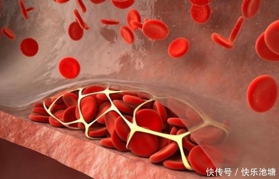软化|血栓的3个表现,平时做到4多,轻松软化血管防血栓