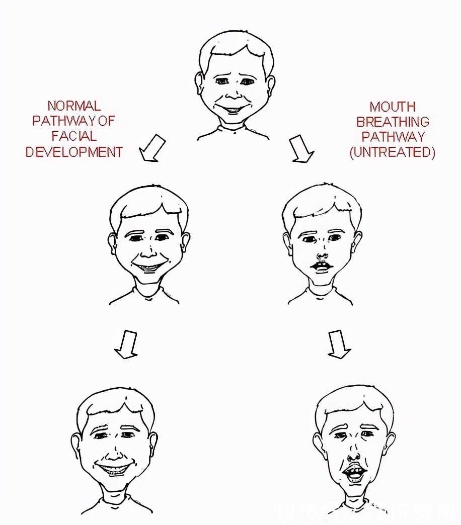 治疗|孩子睡觉总是张口呼吸，难道睡得香？告知家长，或许是这种病引起