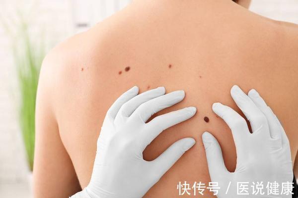 色素痣|皮肤上出现了红痣,还伴随这4种情况,当心是皮肤肿瘤找上门了