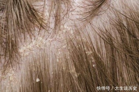 日常生活中|满头都是头皮屑，总是洗不干净？可能是身体出了问题，别忽视！