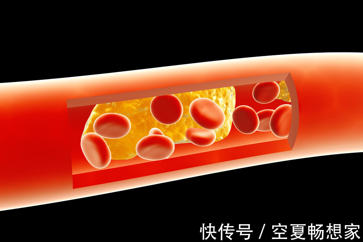 医疗费用|最新研究控制饮食,来降低“坏血脂”,能大大节约医疗费用!