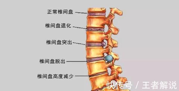 脊髓|什么是颈椎病，对照这些症状，看看你有没有中招