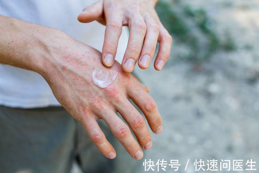 过敏性鼻炎|皮肤反复过敏，是什么原因？如何精准判断过敏原？文章告诉你