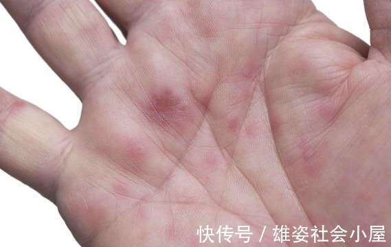 肝脏|肝脏癌变前,上半身或有这4个状况,若你有,希望你别再拖了!