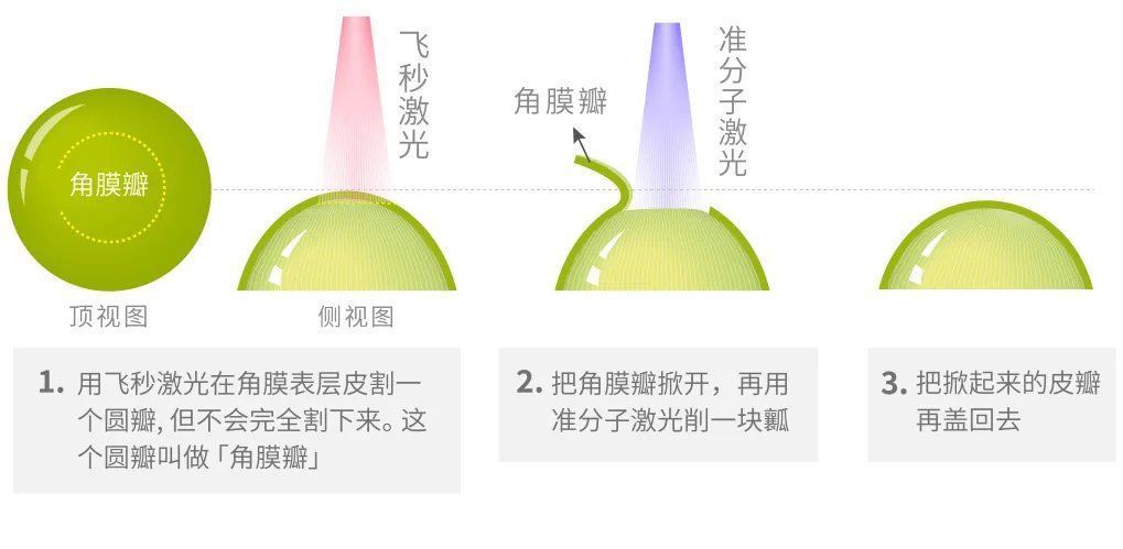 角膜|近视手术该不该做?怎么选?一文给你讲清楚