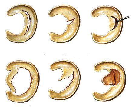 事儿|运动后，你的半月板还好么关于半月板的这点儿事儿！