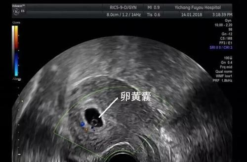 卵黄囊和胎芽同时存在