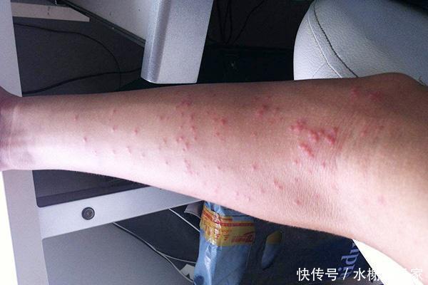 女友半夜全身瘙痒,原因找到!医生:幸好男子没碰