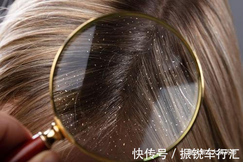 脓包|几天洗一次头最好?头发一湿就用洗发水?几个洗发误区,值得了解