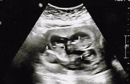 丈夫|25岁孕妈12周肚大如“临盆”，检查后丈夫愁坏了，医生却笑了