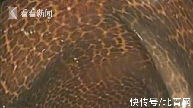 肠子|吓人!阿姨吃3年酵素肠子表面像蛇皮